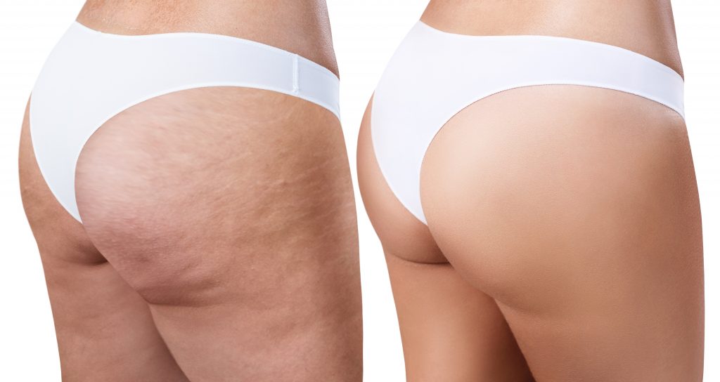 Wie man Cellulite an den Oberschenkeln loswird